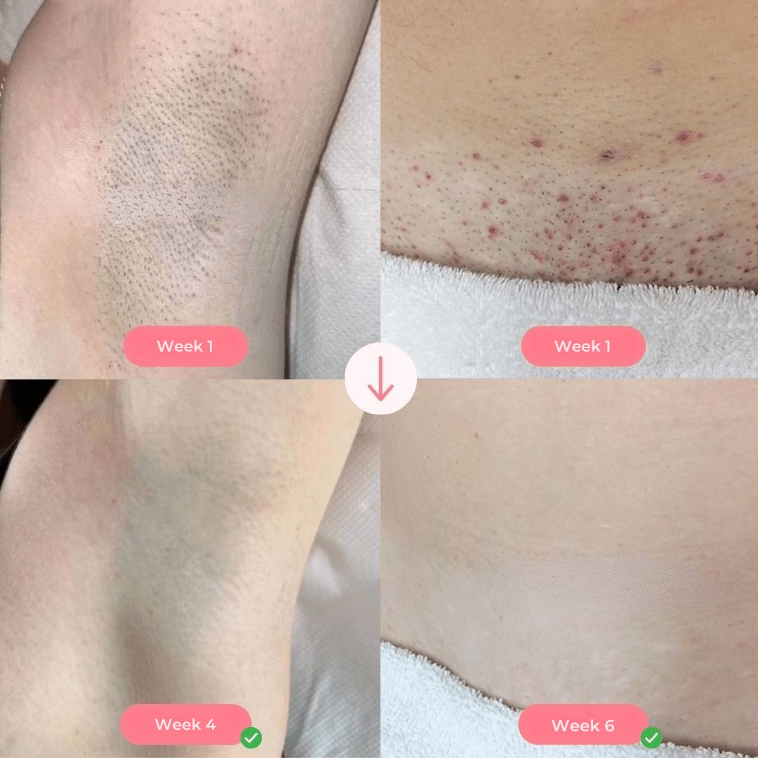 SUPPLY IPL PRO™