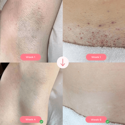 SUPPLY IPL PRO™
